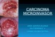 Carcinoma Microinvasor Colpo Clase