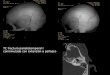 TC fractura parietotemporal I conminutada con extensión a peñasco