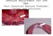 Denture Adjustment for the RDA- Post-Insertion Denture Problems: Causes and Solutions
