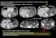 Patiente de 76 ans. ; double pontage coronarien le 08.12.2010 ; choc cardiogénique le 12.12.2010 sur tamponnade : drainage péricardique pour hémopéricarde
