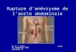 Rupture danévrysme de laorte abdominale Dr P.Le Bléïs Jeudi 06 Septembre 2007 SAU/SAMU 47