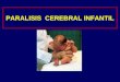 PARALISIS CEREBRAL INFANTIL. Qué es parálisis cerebral infantil (PCI) “ trastorno del tono postural y del movimiento, de carácter persistente ( no invariable