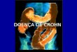 DOENÇA DE CROHN. CONCEITO Doença inflamatória crônica do trato gastrointestinal Colite indeterminada Afeta qualquer parte do TGI – intestino delgado distal