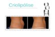 Criolipólise. Definição  Tratamento estético, não-invasivo, que utiliza a técnica de congelamento para redução de medidas e eliminação da gordura localizada