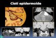 Lesioni espansive dell osso temporale Cisti epidermoide 12