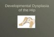 Developmental Dysplasia of the Hip and Ultrasound