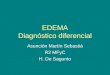Edema .Diagnostico diferencial
