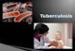 tuberculosis pediatria
