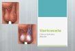 Varicocele 111018230306-phpapp01