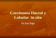 Carcinoma Ductal y Lobular in Situ