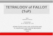 Tetralogy of Fallot - indrayana-