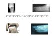 OSTEOCONDROSIS O EPIFISITIS