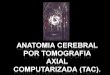 22532045 anatomia-cerebral-por-tomografia-axial