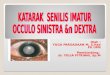 Cataract presus