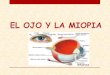 el ojo y la miopia