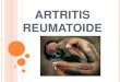 Artritis reumatoide (1)