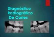 Diagnostico Radiografico de Caries