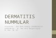 Dermatitis Numularis Ppt