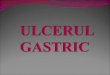 Ulcer Gastric Ff1[1]