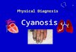 Physical Diagnosis Cyanosis. Definition Cyanosis refers to a bluish( 带蓝色的； 带青色的 )color of the skin and mucous membranes resulting from an increased quantity