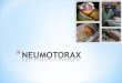 * El neumotórax es una acumulación de aire extrapulmonar dentro del tórax. * 1-2% de todos los RN presenta neumotórax asintomáticos, normalmente unilaterales