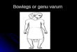Bowlegs or  genu varum