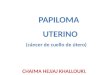 PAPILOMA      UTERINO   (cáncer de cuello de útero) CHAIMA HEJJAJ KHALLOUKI