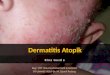 Dermatitis  Atopik