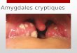 Amygdales cryptiques