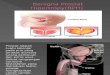Benigna Prostat Hiperplasia(BPH)presentasi.pptx