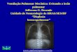Ventilação Pulmonar Mecânica: Evitando a lesão pulmonar Jefferson G. Resende Unidade de Neonatologia do HRAS/SES/DF “Displasia broncopulmonar” 