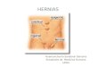 Hernias abdominales, hernia femoral hernia inguinal