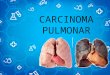 Carcinoma pulmonar