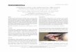 Olgu sunumu Arteriovenous malformation of auricula: Case report