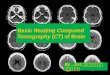 Basic Reading CT Brain