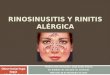 Rinusinusitis y rinitis alergica