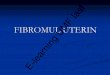 FIBROMUL UTERIN - umfiasi.ro de Medicina... · In caz de fibromiom submucos, miometrul prezinta contractii cu scopul de a-l expulza in cavitatea uterina, iar nodulul fibromatos va