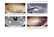 82Cholesteatoma xương đá - ORL-HNS  Web viewTiếp cận cải tiến xuyên ốc tai là phù hợp nhất đối với việc lấy bỏ cholesteatoma xương đá