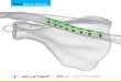 日本メデイカルネクス - Acumed | Innovation With … Amed®鎖骨プレーティングシステム外科技術 3 プレートの選択 整復鉗子を内側および外側の断片に配置するこ