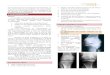 OSTEOARTROSIS - AEEMmedicina-ucr.com/.../uploads/2015/02/4.-Osteoartrosis.docx · Web viewResonancia magnética (RM) se vería más tempranamente. Se traduce como menor espacio articular
