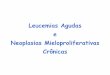 Leucemias Agudas e Neoplasias Mieloproliferativas …hematofmusp.weebly.com/uploads/.../leucemias_agudas... · Leucemias •Agudas: proliferação com bloqueio de diferenciação