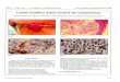 Lesión exofítica sobre cicatriz de mastectomía - Revistaarchivosdermato.org.ar/Uploads/Arch. Argent. Dermatol. 56 33-35... · el 2000 por carcinoma ductal infiltrante, ... siendo