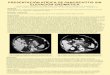 PRESENTACIÓN ATÍPICA DE PANCREATITIS SIN …somivran.es/fileadmin/reuniones/XCongresoPosters... · La intervención quirúrgica de colecciones abdominales secundarias a pancreatitis