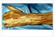 Músculo abdutor longo do polegar - Enfermagem 2013enfermagemflama.weebly.com/uploads/1/1/6/8/11687441/msculos_do... · • Bíceps femural • Origem: Tuberosidade isquiática, linha