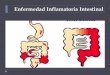 Enfermedad Inflamatoria Intestinalcampus.usal.es/~ogyp/Clases teoricas 2012 2013/Digestivo 5/04. EII.pdf · Enfermedad Inflamatoria Intestinal . Enfermedad Inflamatoria Intestinal