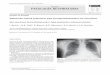 00 Port PatResp 4 - revistadepatologiarespiratoria.org2).pdf · hay consolidación con broncograma aéreo y nódulos centro-lobulillares. El cuadro clínico de larga evolución permite
