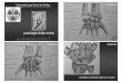 patologie della mano - sunhope.it · sindrome del tunnel carpale acroparestesie e neurite del ramo tenare Brain (Lancet 1947) compressione del mediano al retinacolo dei flessori 