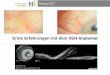 Erste Erfahrungen mit dem XEN-Implantat - kssg.ch · Ophtag 2017 Titel der Präsentation XEN – Material ( Originalton Hersteller übersetzt) Hydrophiles zylindrisches Implantat