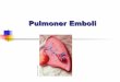Pulmoner Emboli - Varis Egevarisege.com/upload/5/emboli.pdf · 2016-06-27 · PE için akut olgularda ölüm oranı %7 ile 11 arasında değişmektedir (4). ABD’de yıllık insidansın