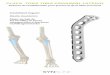 PLACA TORX TIBIA PROXIMAL LATERAL - Synbone · 2015-03-26 · Las placas Torx de Tibia Proximal Lateral están indicadas para la estabilización delas fracturas de la porción proximal